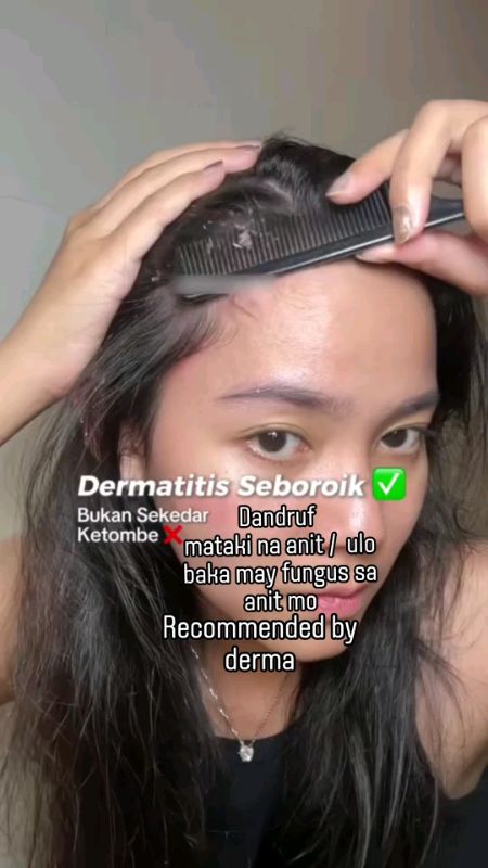 Ketoconazole Anti Dandruff Shampoo for Itchy Scalp Oily Hair  Deep Cleansing Hair Mask #dandruff #ketoconazole #makatinganit #itchyscalp #hair #buhok