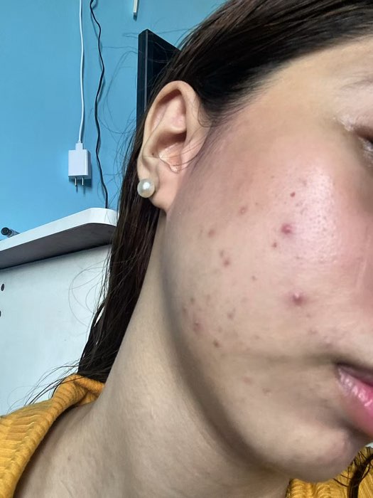 3 weeks in and I see some changes. Not sponsored (but if they wanna, I won't say no 😉). Just my honest review, results may vary by skin type. #shopee