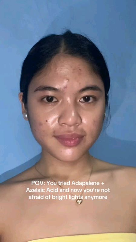 para sa maraming pimples at dark spot #azelaicacid #FreeCoinsInShopeeVideo #MasMuraSaShopee #shopeeph #fyp #trending #viral #ShopeePHPaydaySale
