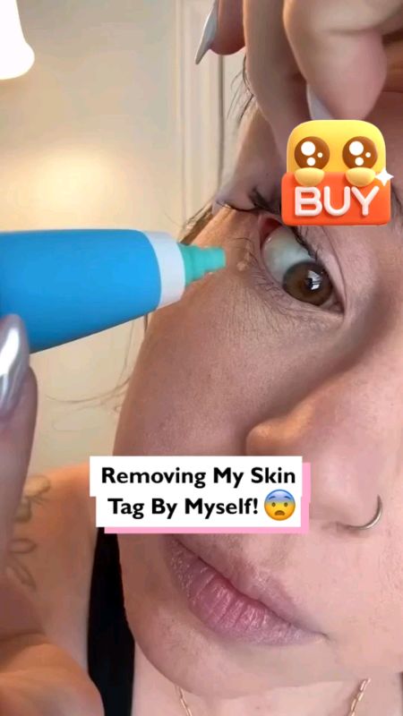 #AutoSkinTagRemover #skintagremover #skintag #mole #warts #wartsremover