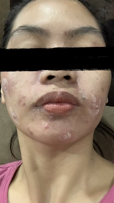 Anti acne #antiacne #acnecream #acnegel #benzac #benzoylperoxide #acnejourney