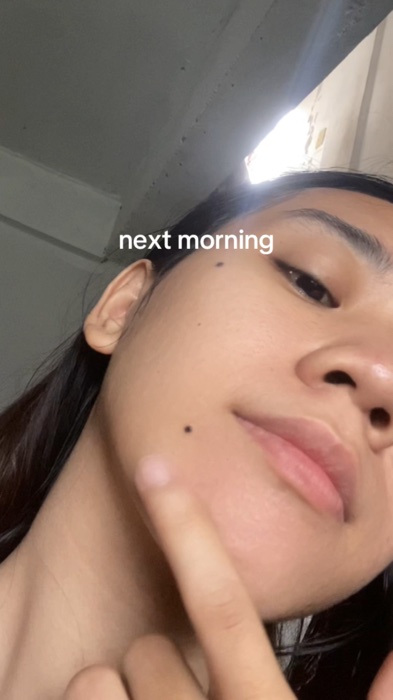 #dralthea #345cream #acnetreatment #realpostacnecream #draltheashopee