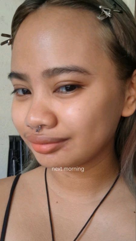 #dralthea #345cream #acnetreatment #realpostacnecream #draltheashopee